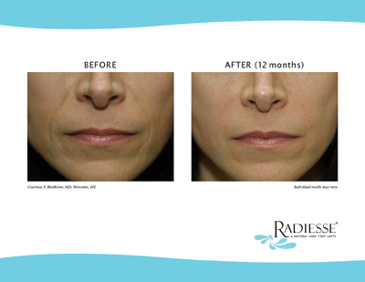 Radiesse® is a calcium-based dermal filler that restores volume in the cheeks and areas of the lower face to treat moderate to severe wrinkles and folds. It can last up to a year! We often use this product in men who need a firmer solution to volume loss and skin folds.Learn More