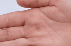 Medical Laser Solutions - Common Warts