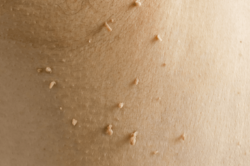 Medical Laser Solutions - Skin Tags
