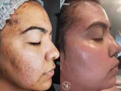Medical Laser Solutions - VI Peel - Precision Plus with Purify