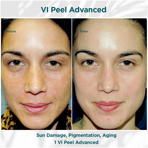 Vi Peels® Medical Laser Solutions 