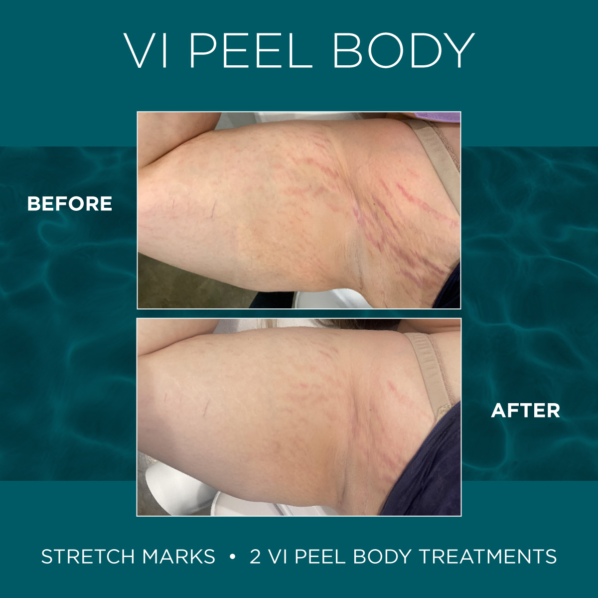 Vi Peels® Medical Laser Solutions 9063