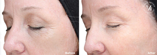 before-and-after-1-vi-peel-advanced